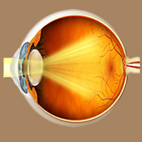 Cataract