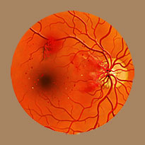 Diabetic Retinopathy