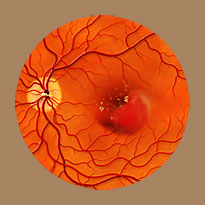 Macular Degeneration
