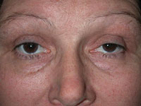 Eyelid Surgery