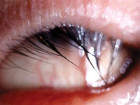 Misdirected Eyelashes