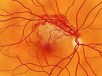 Retinal Vein Occlusion