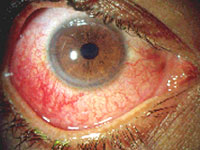 Uveitis